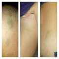 seat belt anchor bruise
